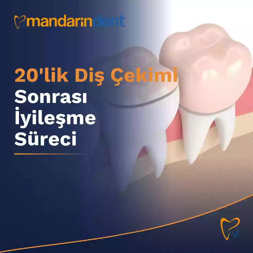 20'lik diş çekimi sonrası iyileşme süreci – yirmilik diş çekimi
