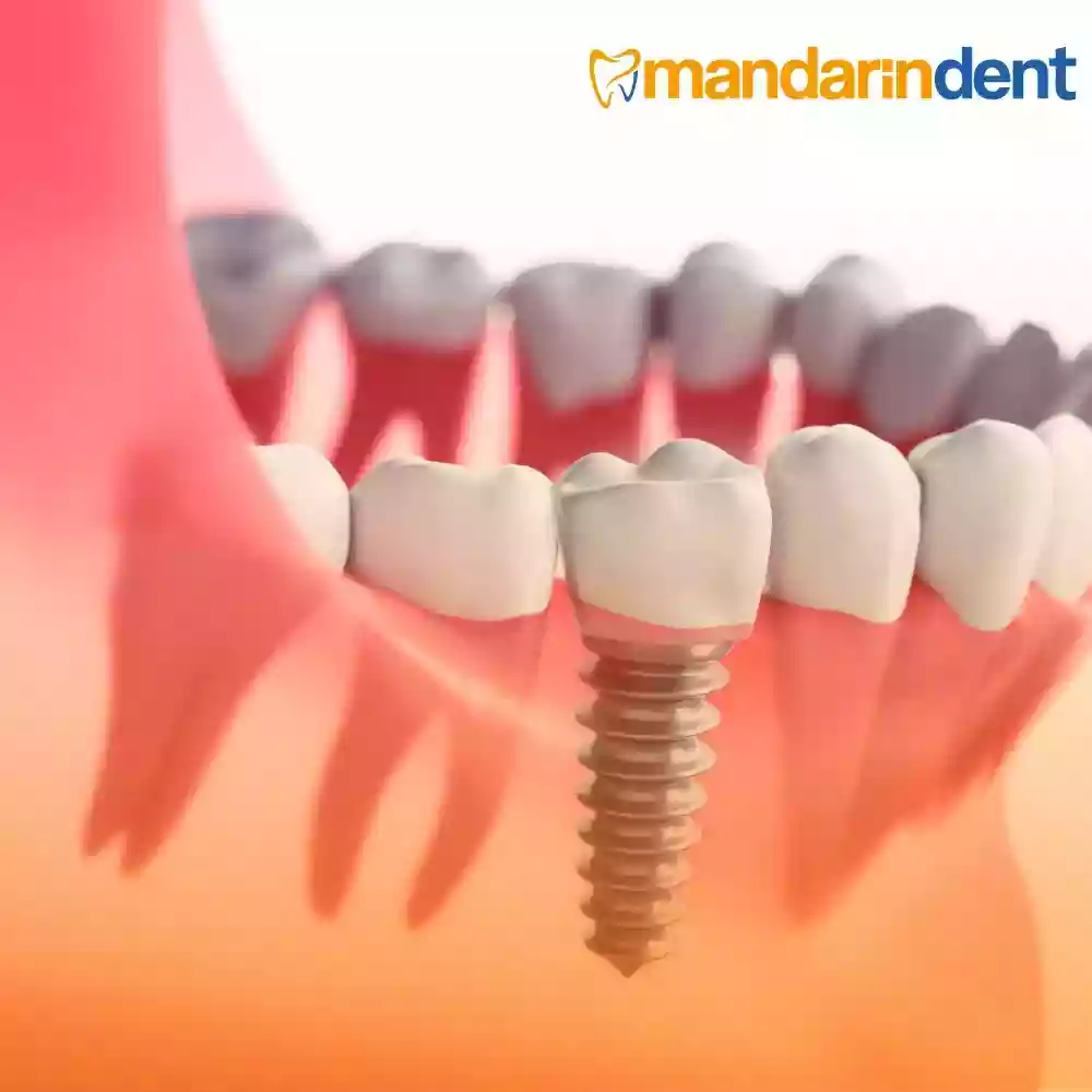 All-on-4 İmplant Tedavisi Nedir? – Tam dişsizlikte implantlar üzerinde sabit protez yaklaşımı