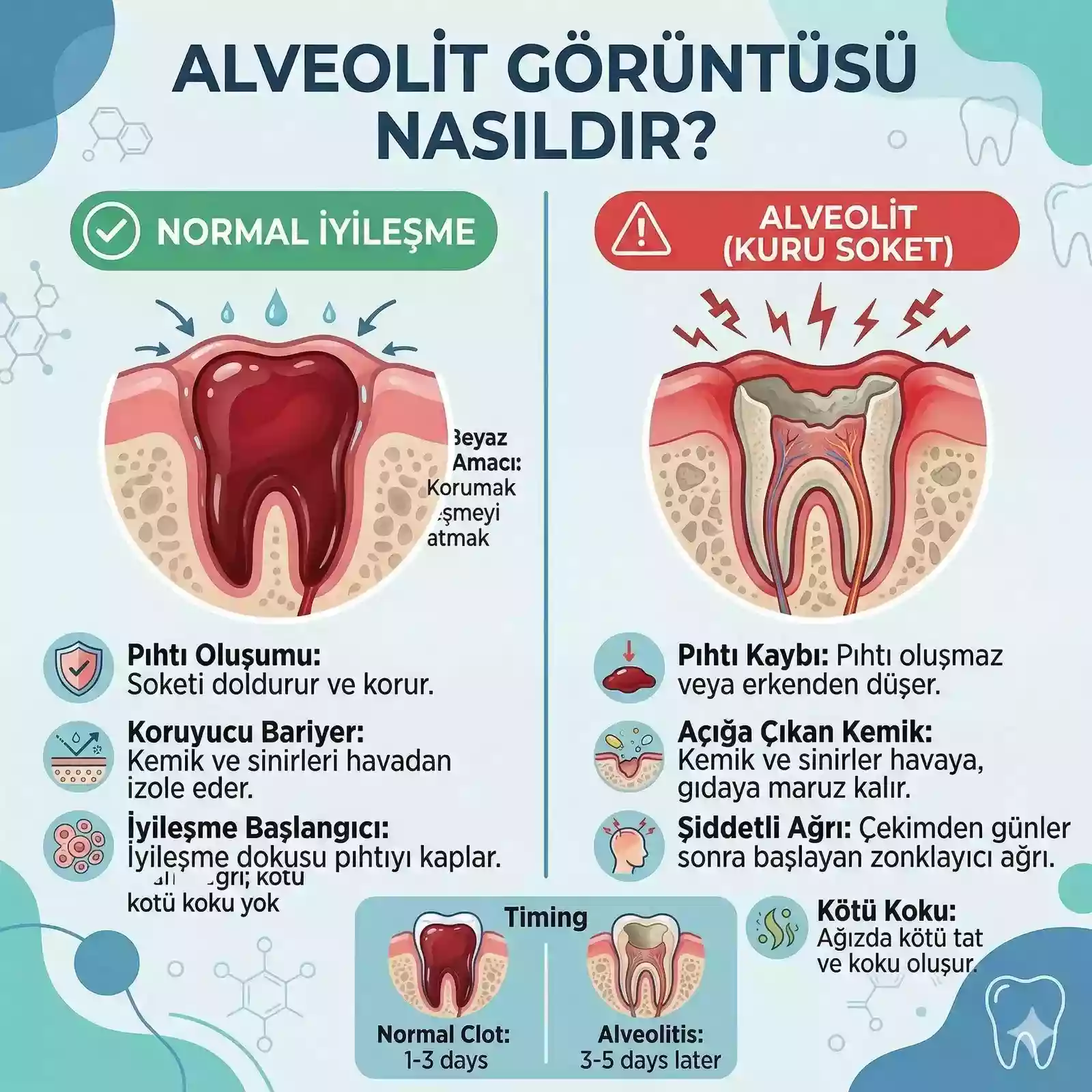 Diş çekiminden sonra pıhtı ve alveolit – kuru soket görünümü