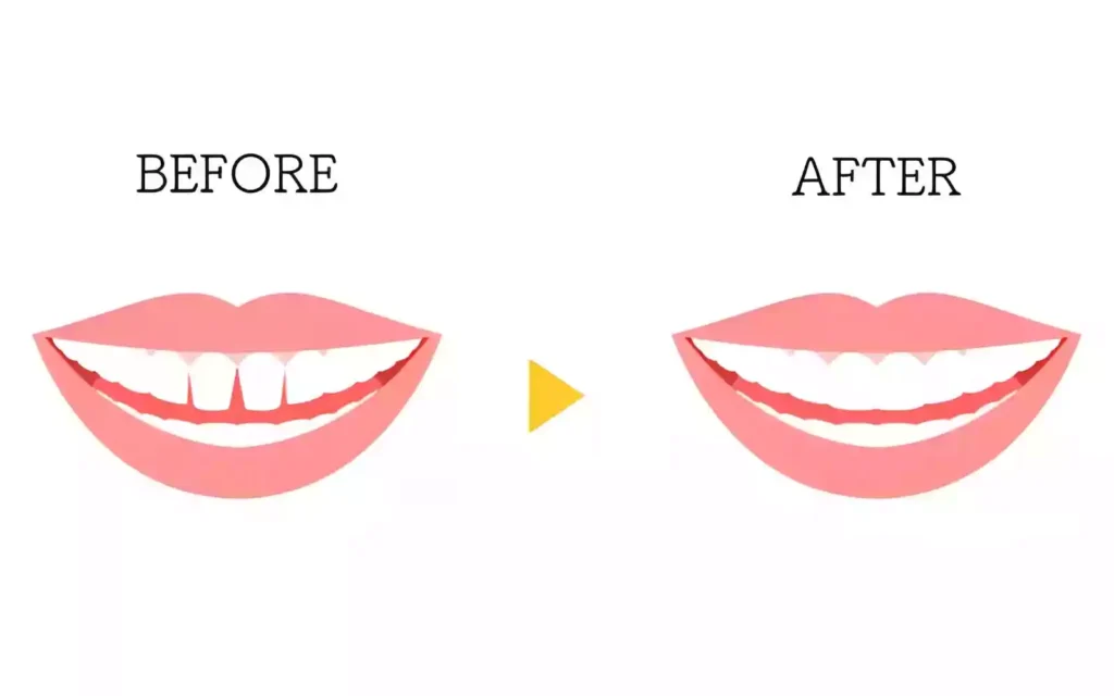 Ayrık Diş (Diastema) Tedavisi