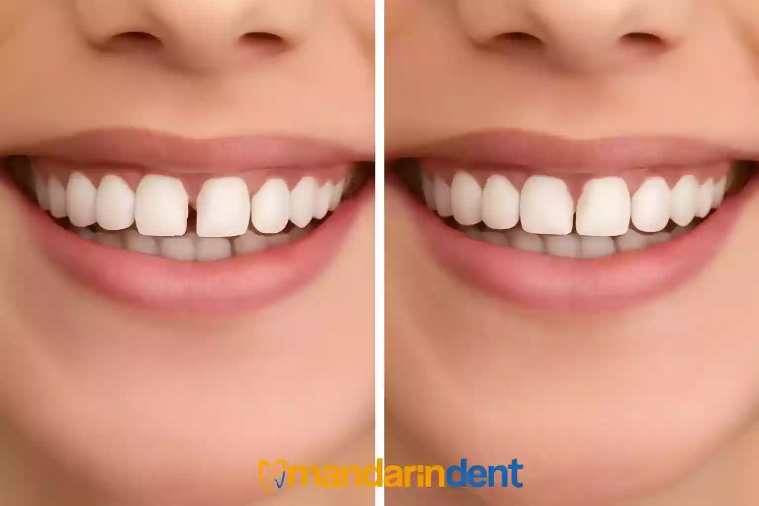 Ayrık Diş (Diastema) Tedavisi