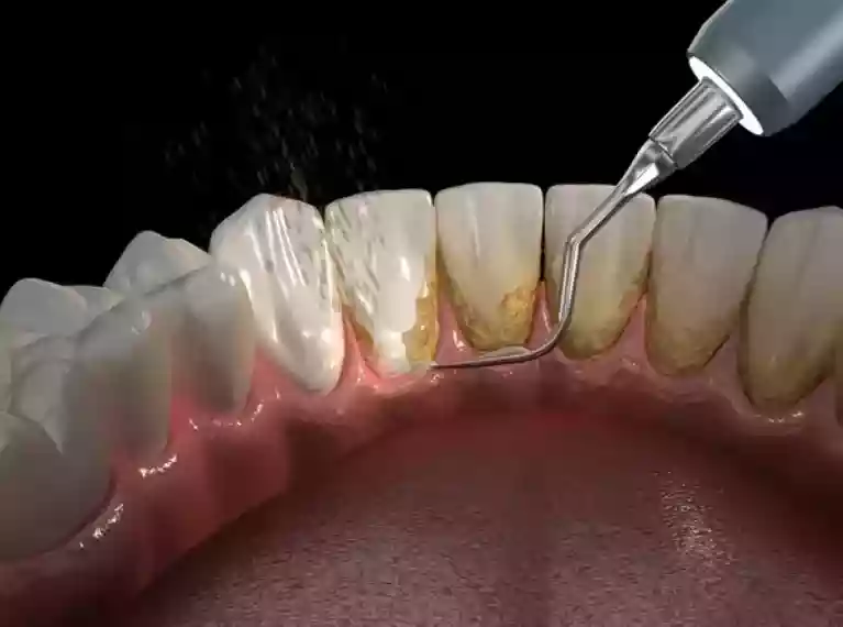 Diş taşı temizliği sonrası oluşan boşluk – boşluk hissinin kalıcı olup olmadığı