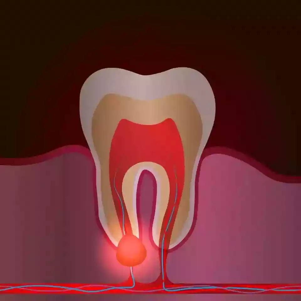 Bodrum Oral Surgery Procedures jaw cyst surgery