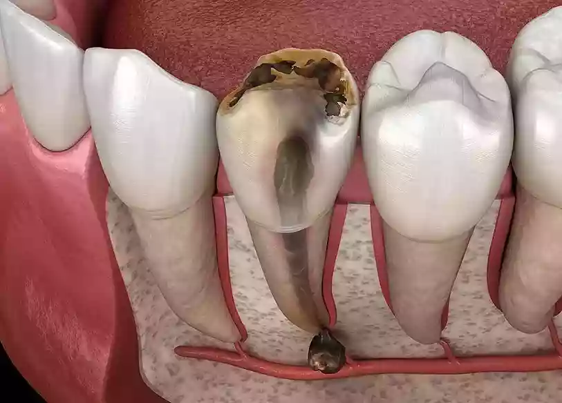 Bodrum Oral Surgery Procedures jaw cyst X-ray