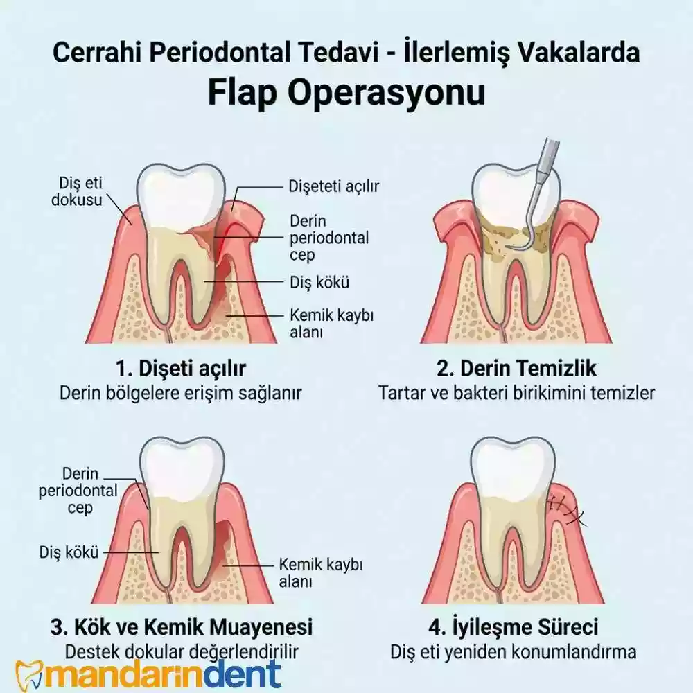 Cerrahi Periodontal Tedavi