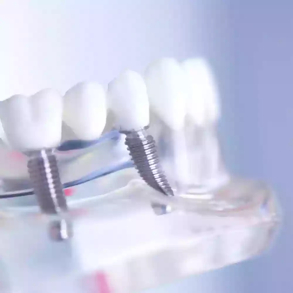 Bodrum Dental Implant Treatments: Permanent Solutions for Missing Teeth - Multiple Implants