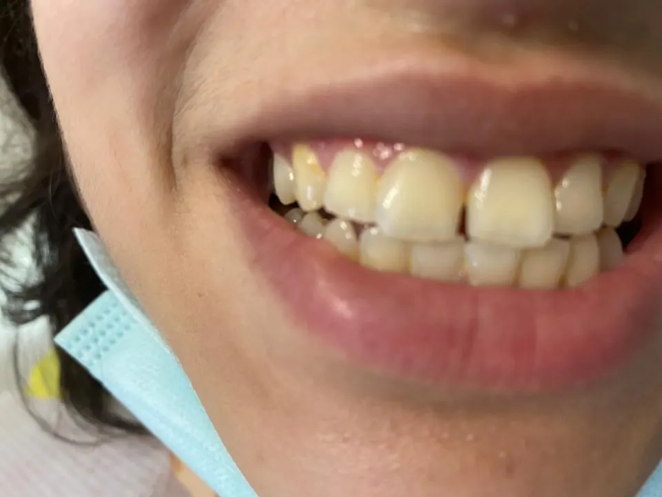 Composite bonding before treatment at MandarinDent Bodrum