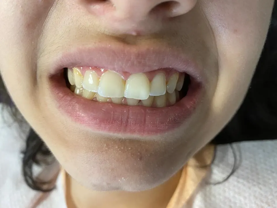 Composite bonding after treatment at MandarinDent Bodrum