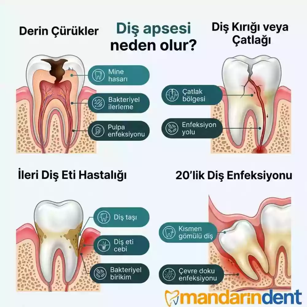 Diş Apsesi Neden Olur