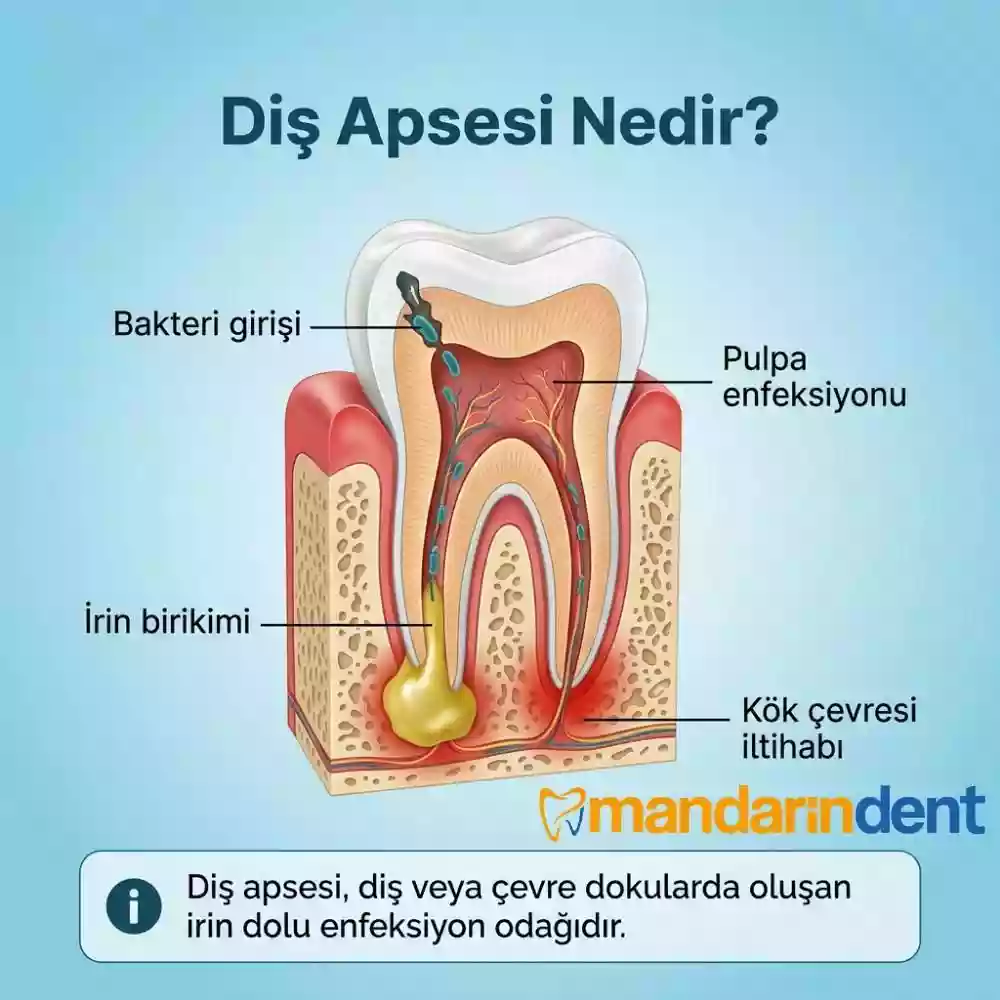 Diş Apsesi Nedir