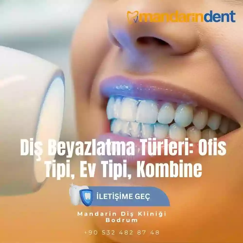Diş beyazlatma türleri ofis tipi ev tipi ve kombine Diş beyazlatma türleri ofis tipi ev tipi ve kombine