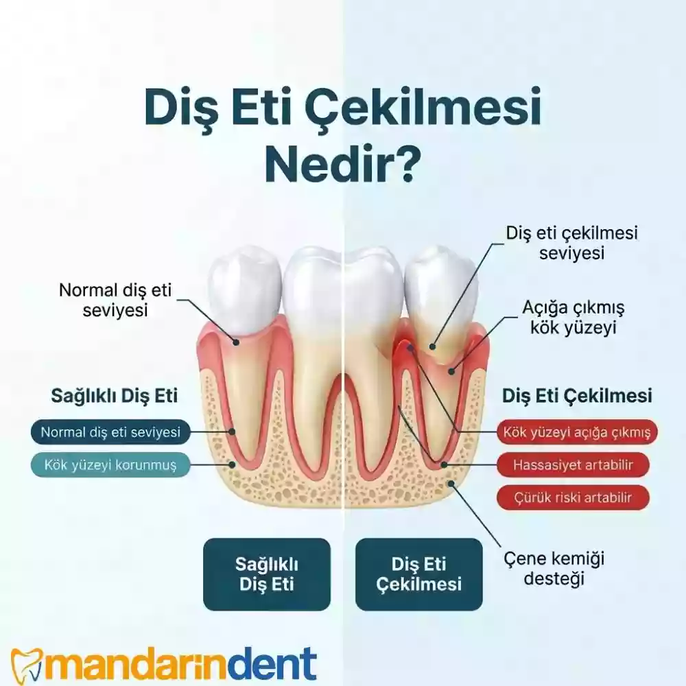 Diş Eti Çekilmesi Nedir?