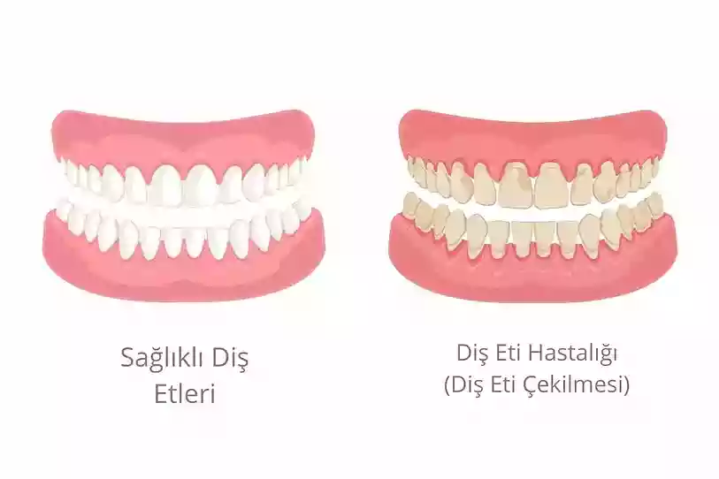 Bodrum Gum Diseases and Treatments - Periodontal examination at MandarinDent