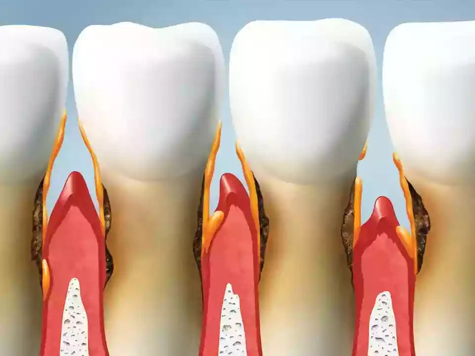 Bodrum Gum Diseases and Treatments - Symptoms of gum recession