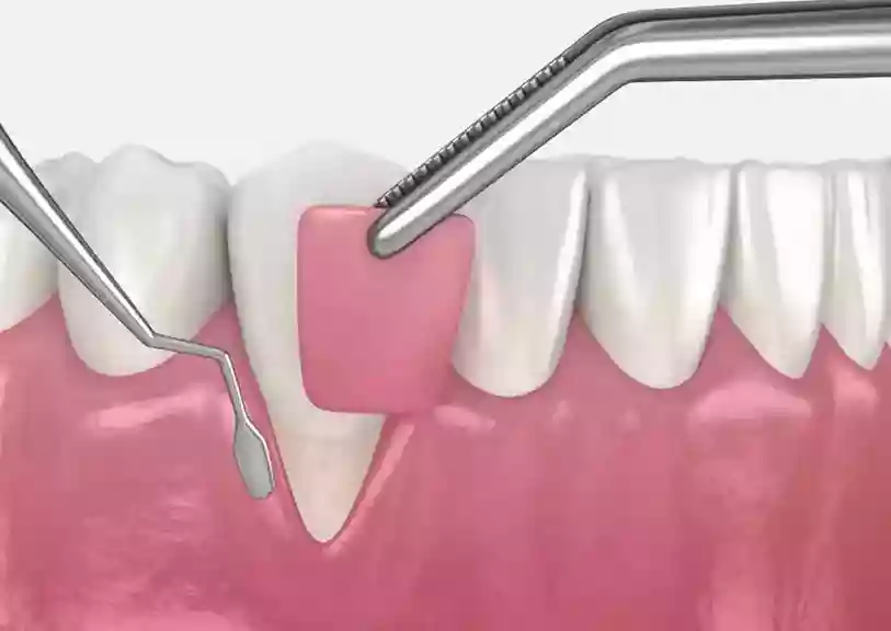 Bodrum Gum Diseases and Treatments gum graft surgery