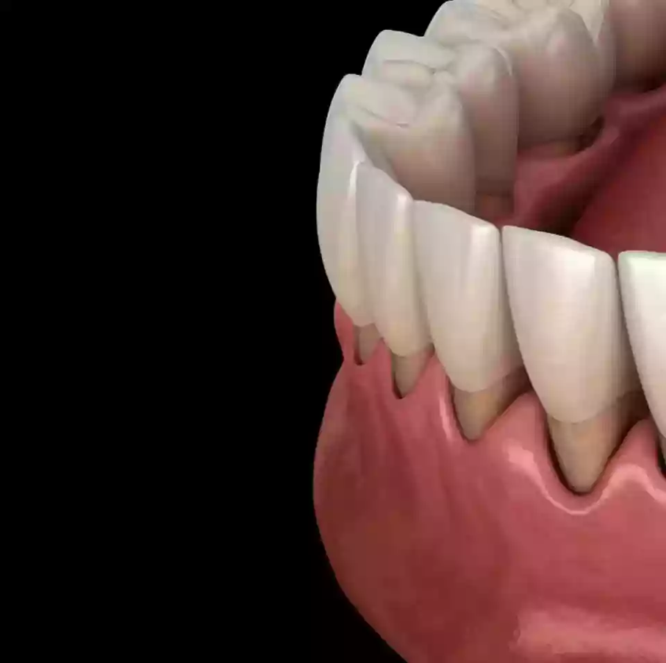 Bodrum Gum Diseases and Treatments - Gum graft surgery procedure