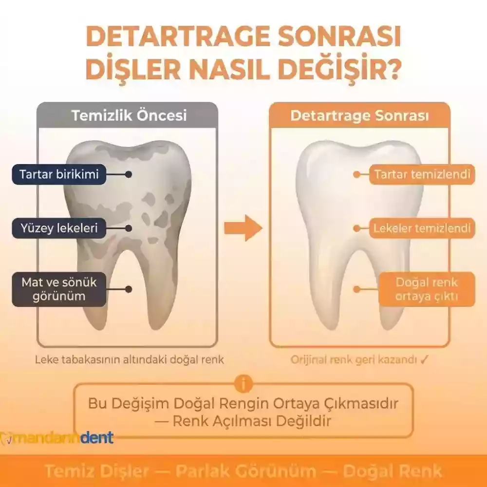 Diş taşı temizliği dişleri beyazlatır mı yüzey lekeleri ve doğal renk Diş taşı temizliği dişleri beyazlatır mı yüzey lekeleri ve doğal renk