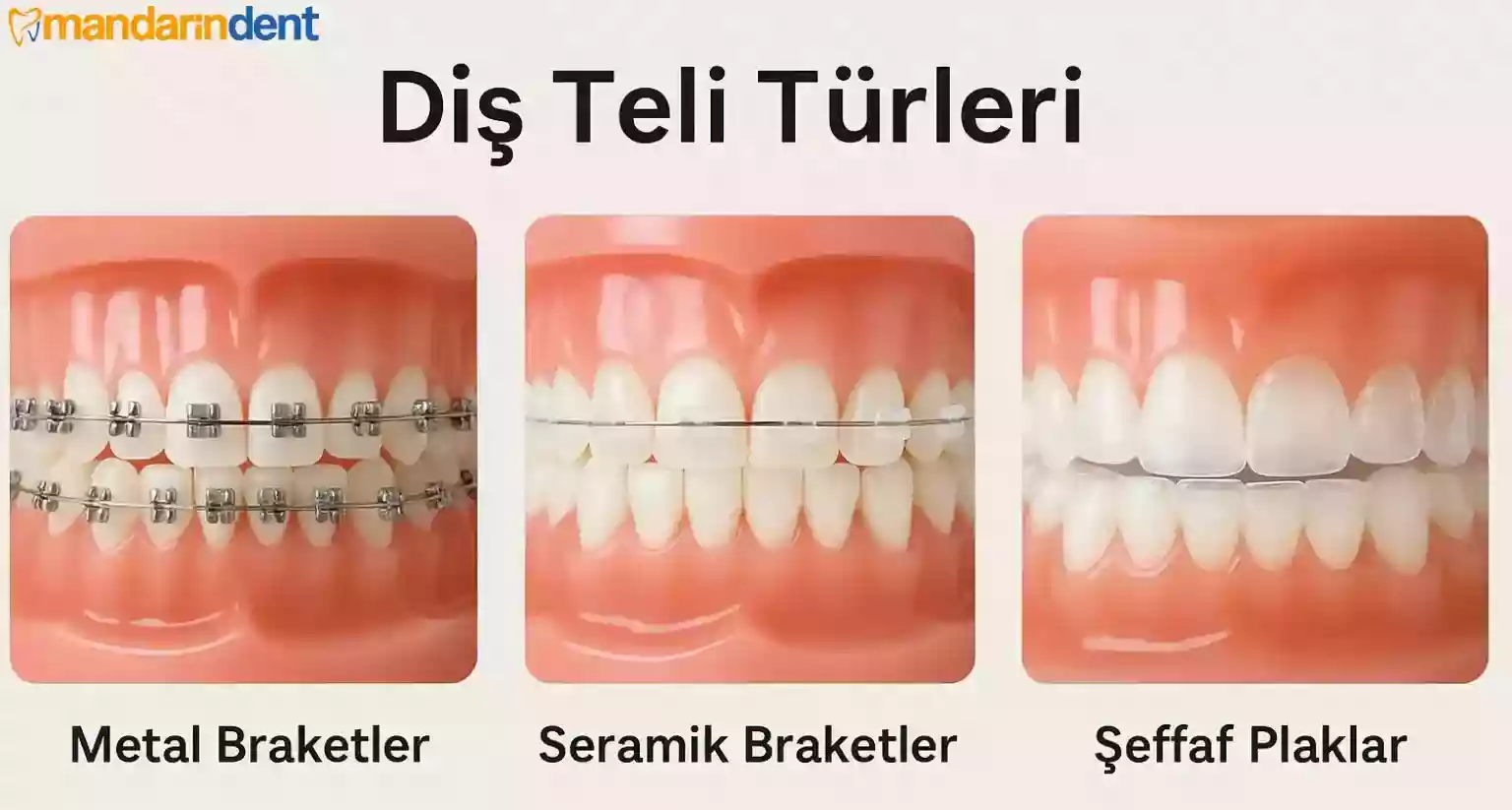 Diş Teli Türleri