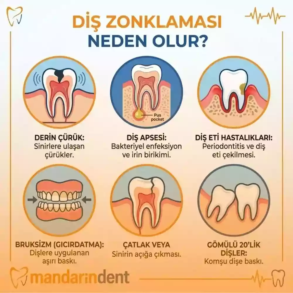 Zonklayan diş ağrısına ne iyi gelir, nedenleri ve tedavisi – Neden olur?
