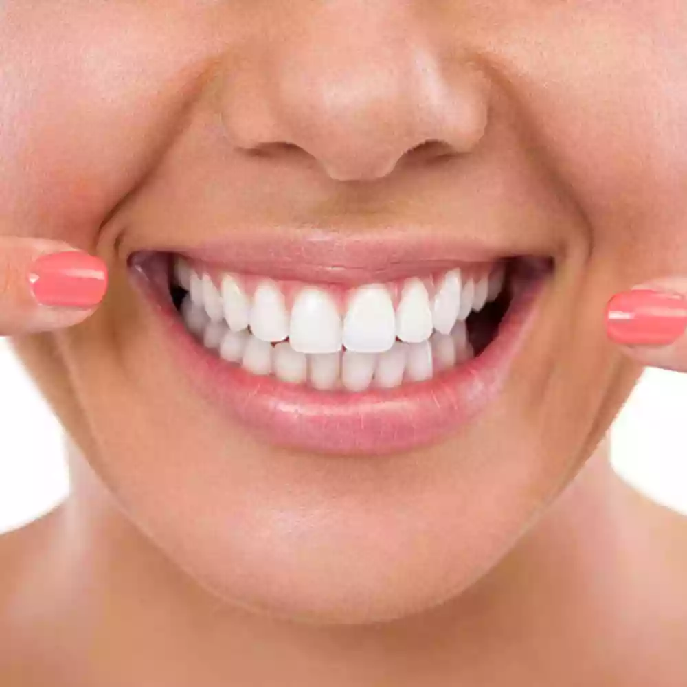Bodrum Teeth Whitening (Bleaching) at-home whitening trays