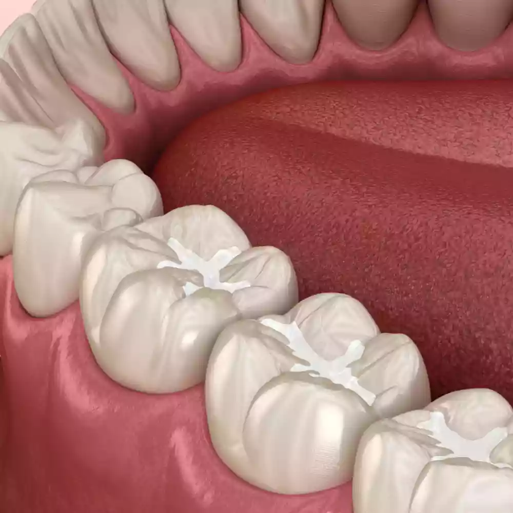 Bodrum Pediatric Dentistry (Pedodontics) fissure sealant coating
