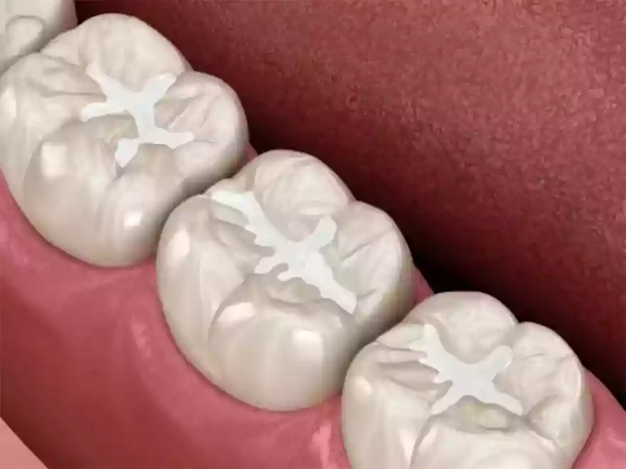 Bodrum Pediatric Dentistry (Pedodontics) - Sealant procedure