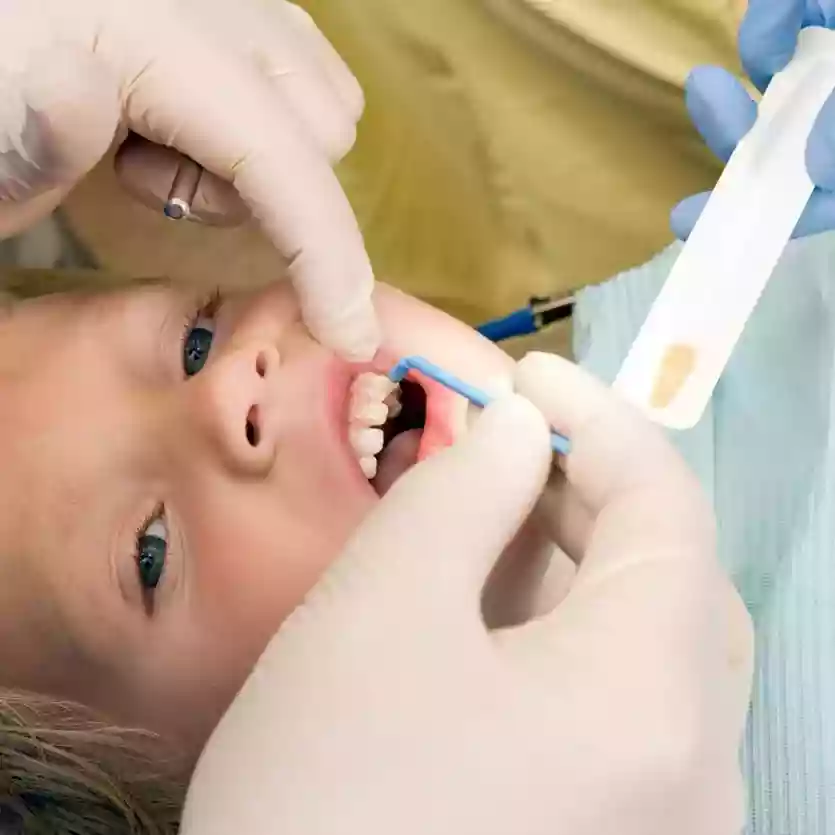 Bodrum Pediatric Dentistry (Pedodontics) professional fluoride treatment