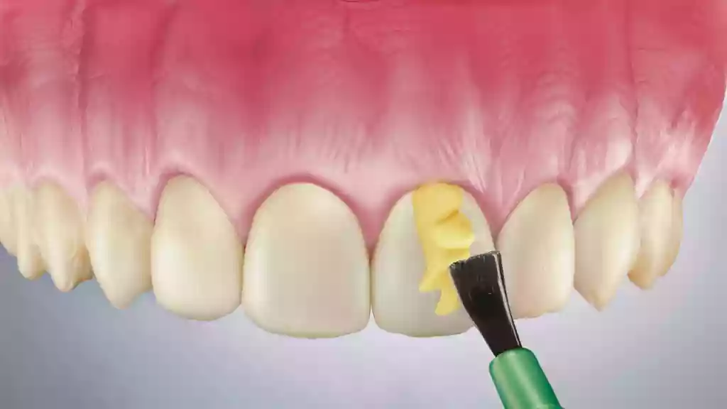 Bodrum Pediatric Dentistry (Pedodontics) - Child fluoride treatment