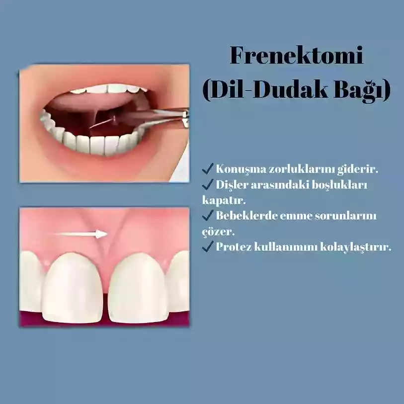 Bodrum Oral Surgery Procedures frenectomy