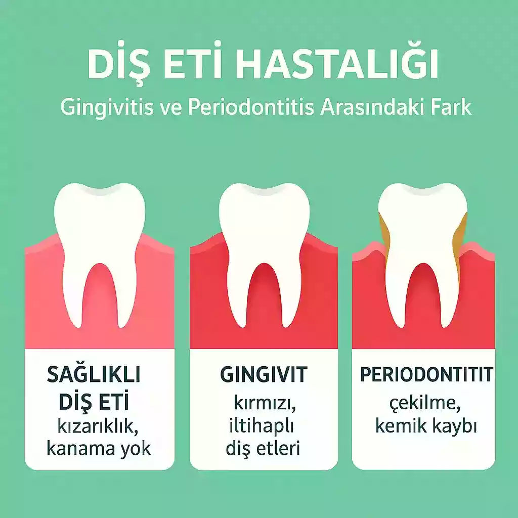 Gingivitis ve Periodontitis Arasındaki Fark: Diş eti iltihabı ve kemik kaybı