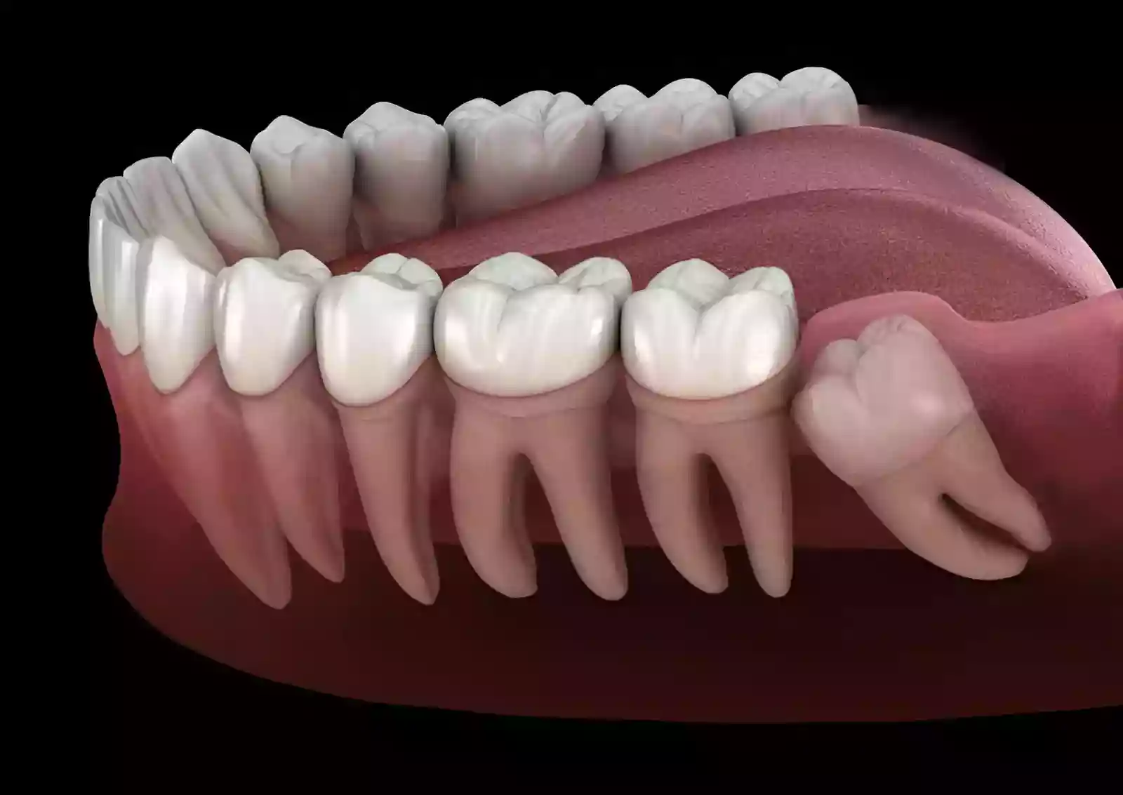 Bodrum Oral Surgery Procedures impacted wisdom tooth X-ray