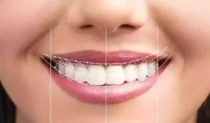 Bodrum estetik diş hekimliği gülüş tasarımı