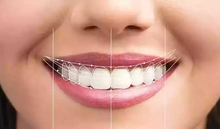 Bodrum estetik diş hekimliği – gülüş tasarımı planlaması