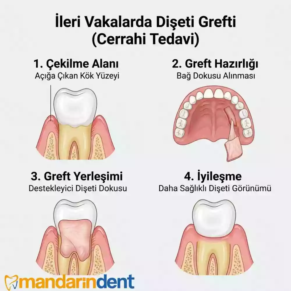 İleri Vakalarda Diş Eti Grefti (Cerrahi Tedavi)