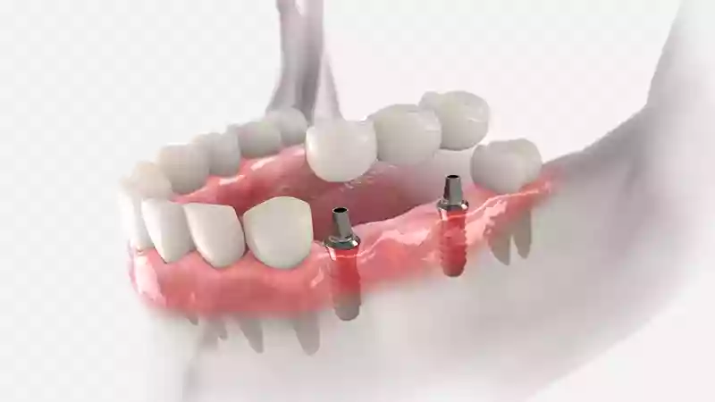 Bodrum dental prosthesis treatments implant-supported prostheses