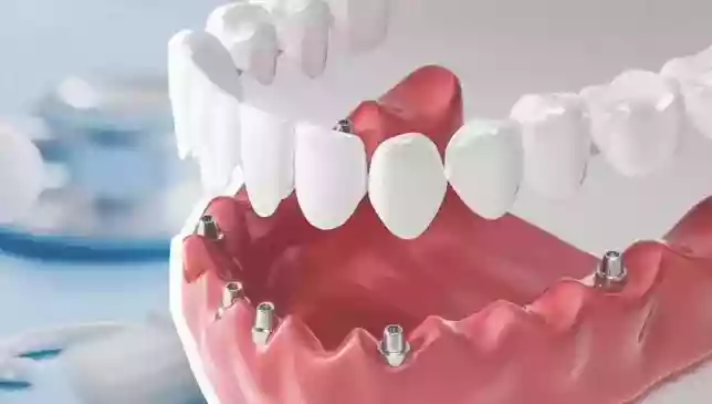 Bodrum dental prosthesis treatments – fixed and removable implant prostheses
