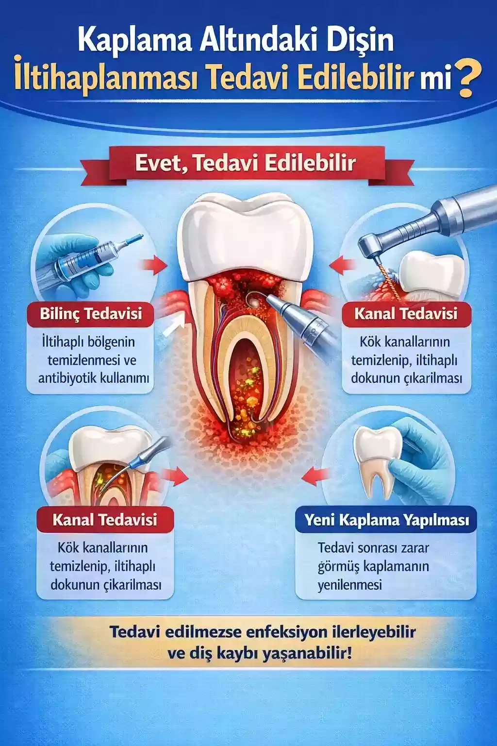 Kaplama altındaki dişin iltihaplanması – Tedavi edilebilir mi?