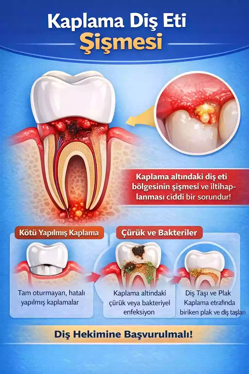 Kaplama altındaki dişin iltihaplanması – Diş eti şişmesi