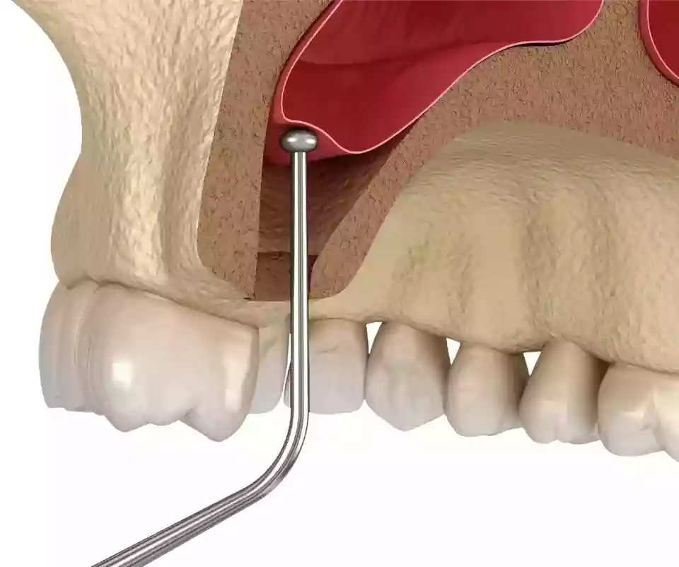 Bodrum Dental Implant Treatments: Permanent Solutions for Missing Teeth - Bone Grafting