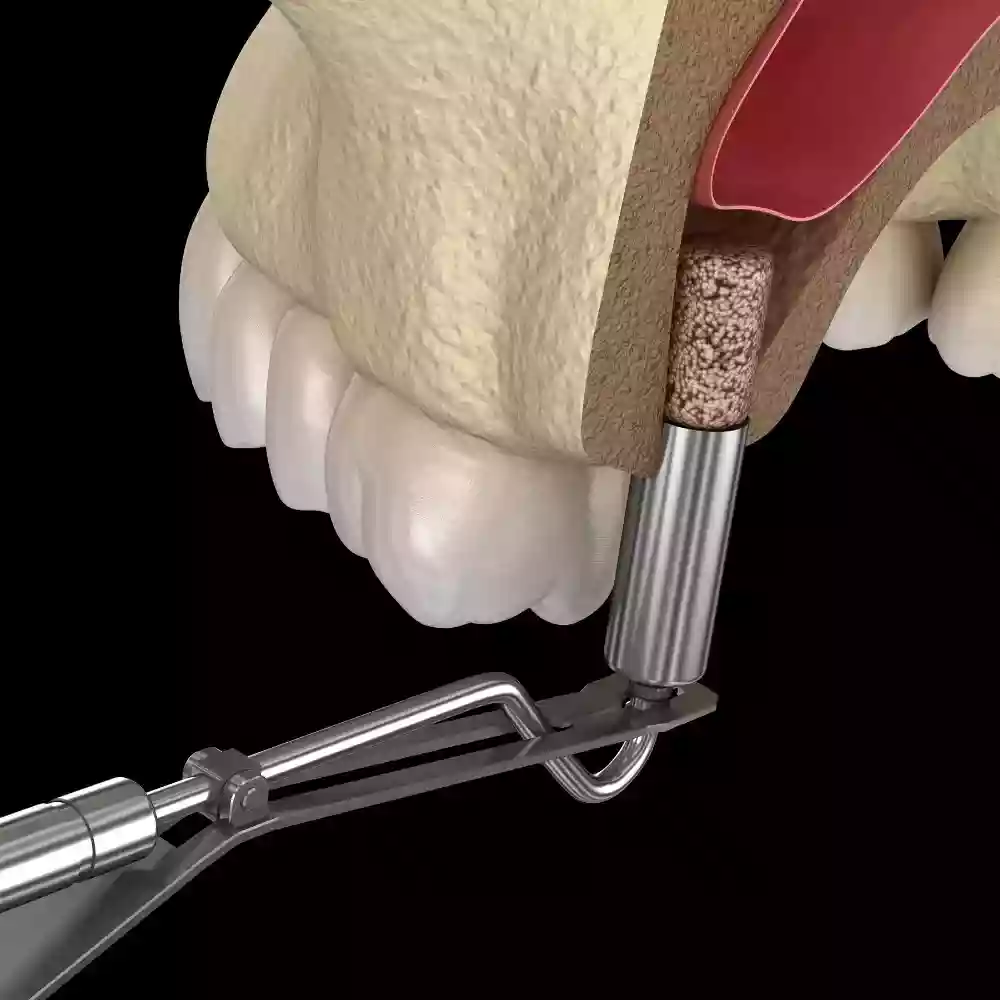Bodrum Dental Implant Treatments: Permanent Solutions for Missing Teeth - Sinus Lift