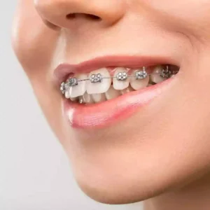 Bodrum ortodonti metal diş telleri