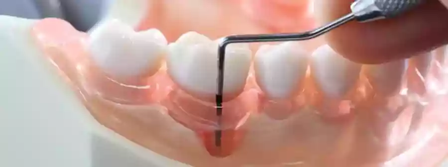 Bodrum Gum Diseases and Treatments - Periodontal curettage and surgical stages