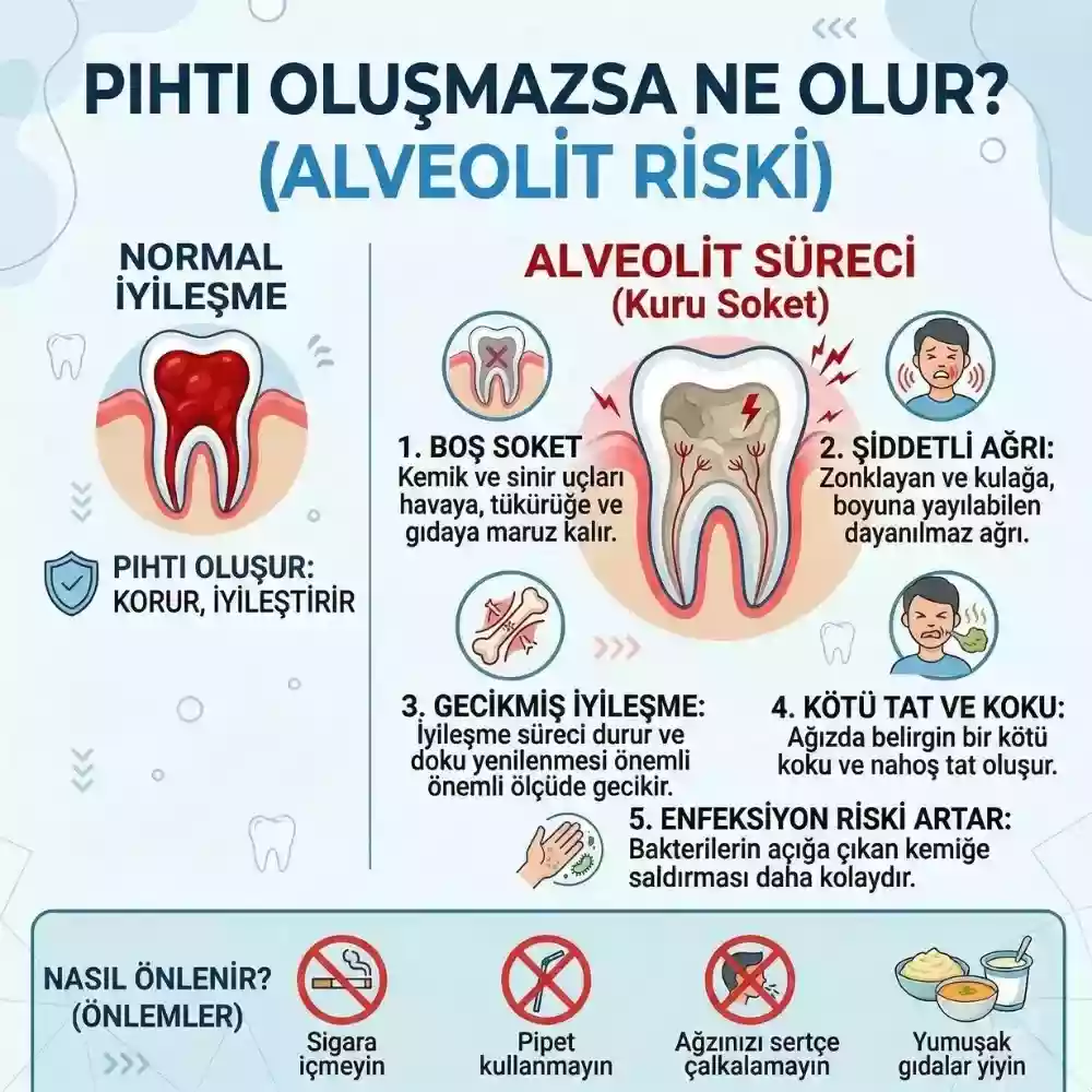 Diş çekiminden sonra pıhtı ve alveolit – pıhtı oluşmazsa ne olur