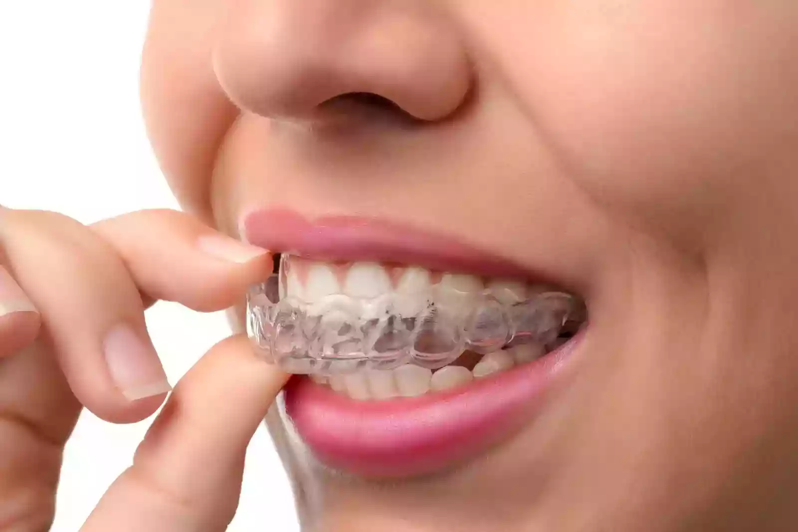 Bodrum ortodonti – şeffaf plaklar (Invisalign) tedavisi, MandarinDent