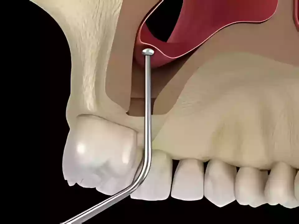 Bodrum Oral Surgery Procedures sinus lifting