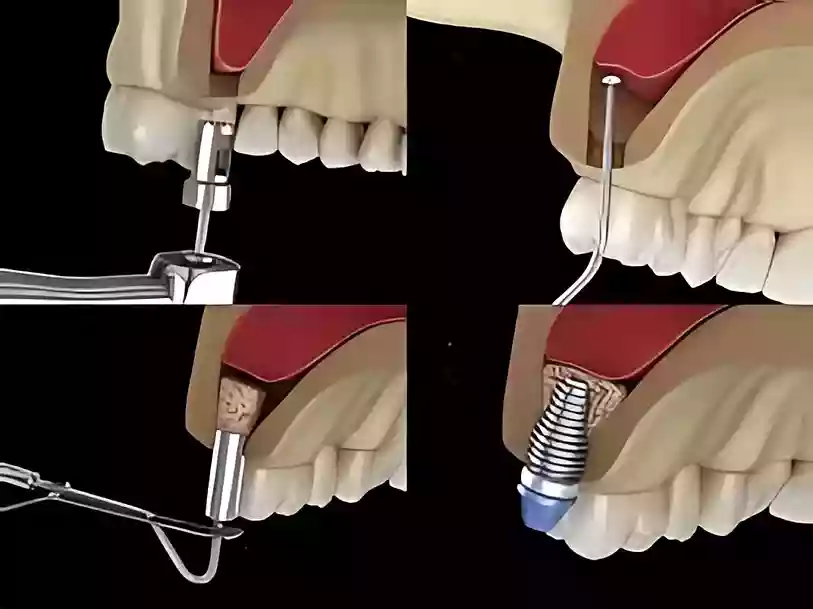 Bodrum Oral Surgery Procedures sinus lifting treatment