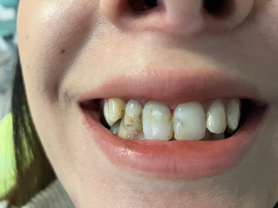 Smile design before treatment at MandarinDent Bodrum