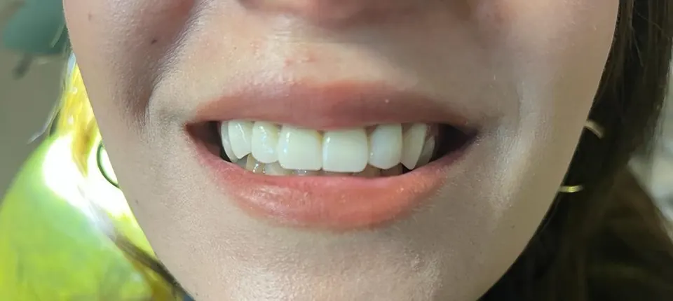 Smile design after treatment at MandarinDent Bodrum