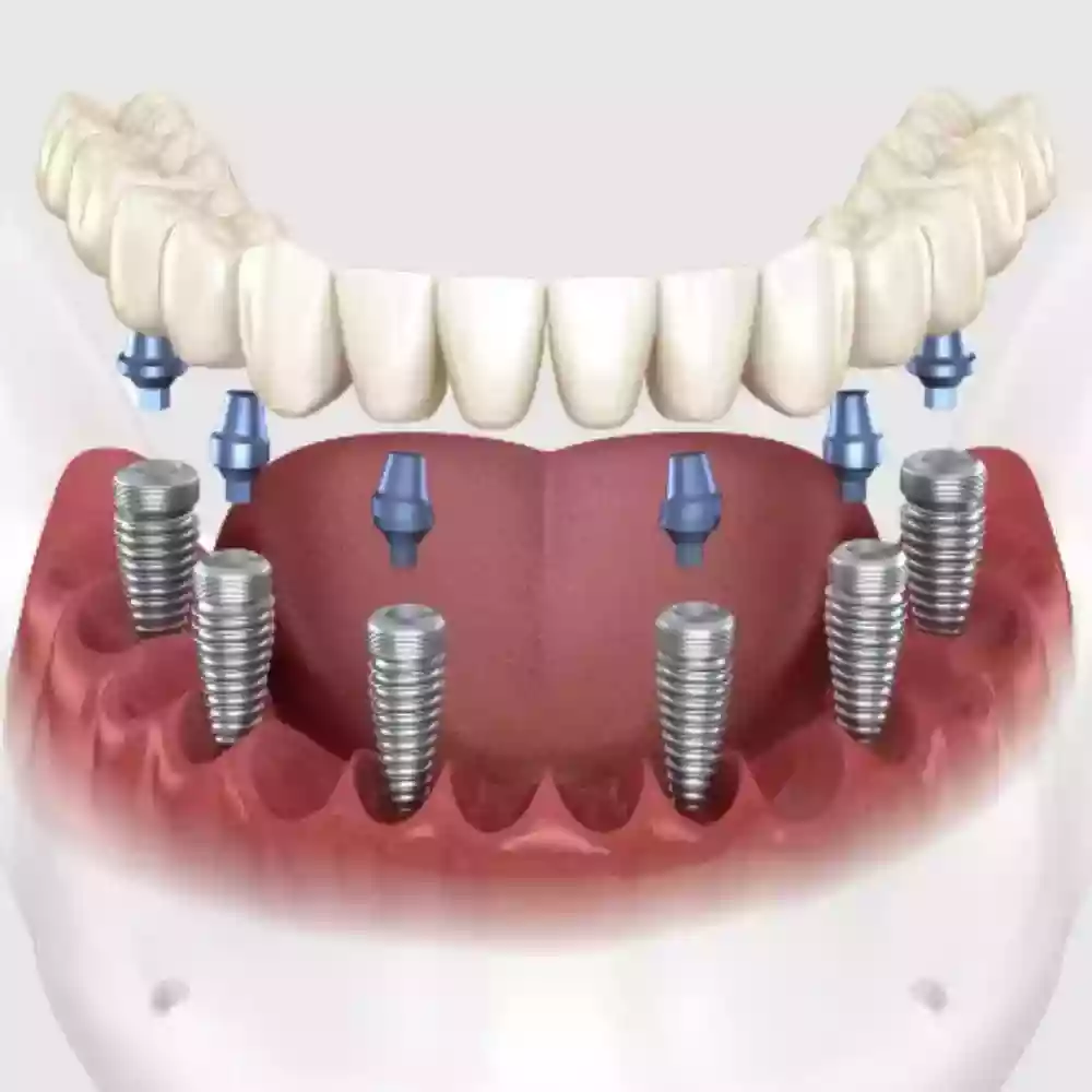 Bodrum Dental Implant Treatments: Permanent Solutions for Missing Teeth - Full Mouth