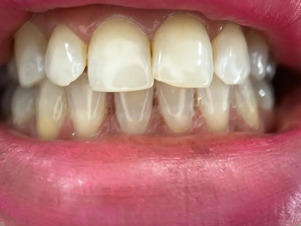 Teeth straightening before treatment at MandarinDent Bodrum